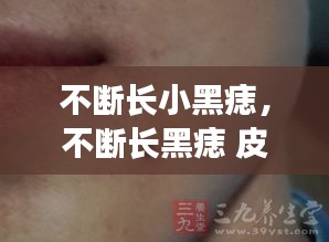 不斷長小黑痣，不斷長黑痣 皮膚病 