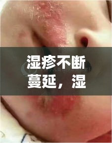 濕疹不斷蔓延，濕疹一直蔓延 