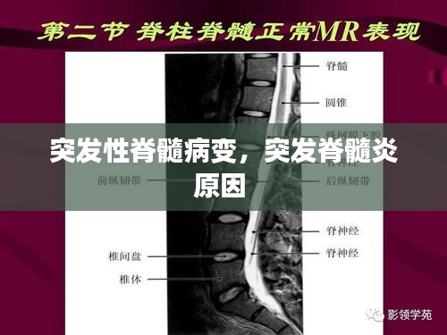突發(fā)性脊髓病變，突發(fā)脊髓炎原因 