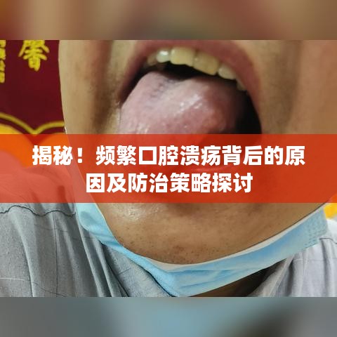 揭秘！頻繁口腔潰瘍背后的原因及防治策略探討