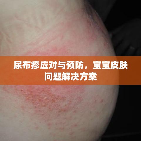 尿布疹應(yīng)對(duì)與預(yù)防，寶寶皮膚問題解決方案