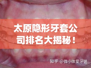 太原隱形牙套公司排名大揭秘！專業(yè)矯正牙齒，打造自信笑容！